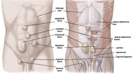 Fıtık onarım şeması / ameliyat sonrası örnek