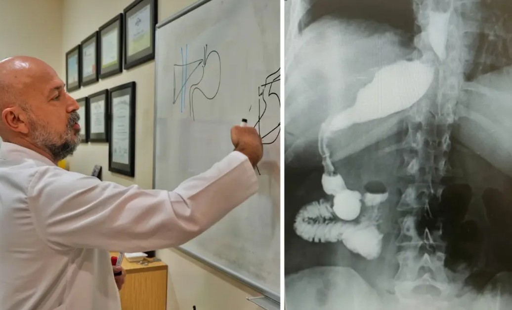 Mide Ters Ameliyatı