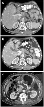 Pankreas görüntüsü / cerrahi örnek 1
